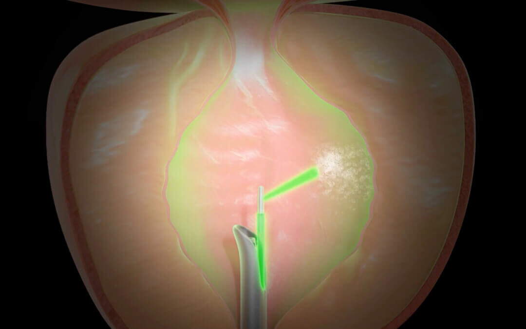 Vantagens do Greenlight Laser na Hiperplasia Prostática Benigna